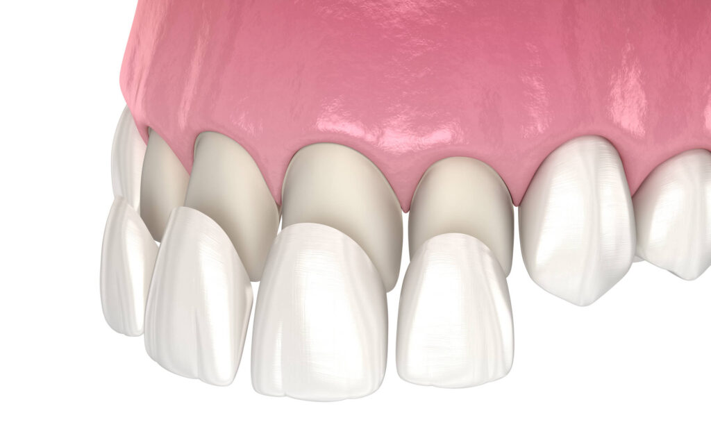 Carillas Dentales