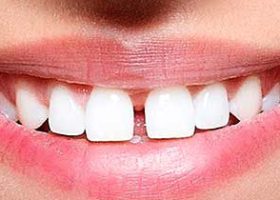 Dientes Separados