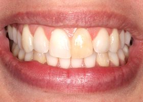 Dientes Decolorados o Manchados