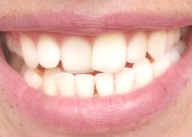 Dientes Levemente Girados