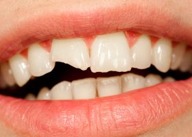 Dientes Rotos