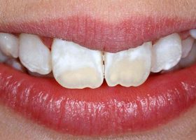 Dientes Manchados