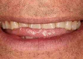 Dientes Desgastados